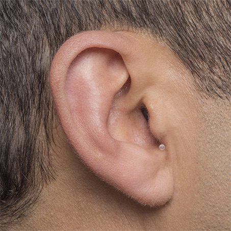 Invisible-In-the-Canal (IIC) hearing aid style